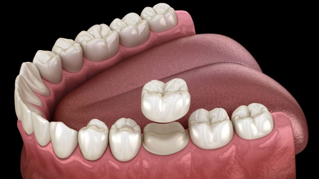 Dental Crown Placement Illustration
