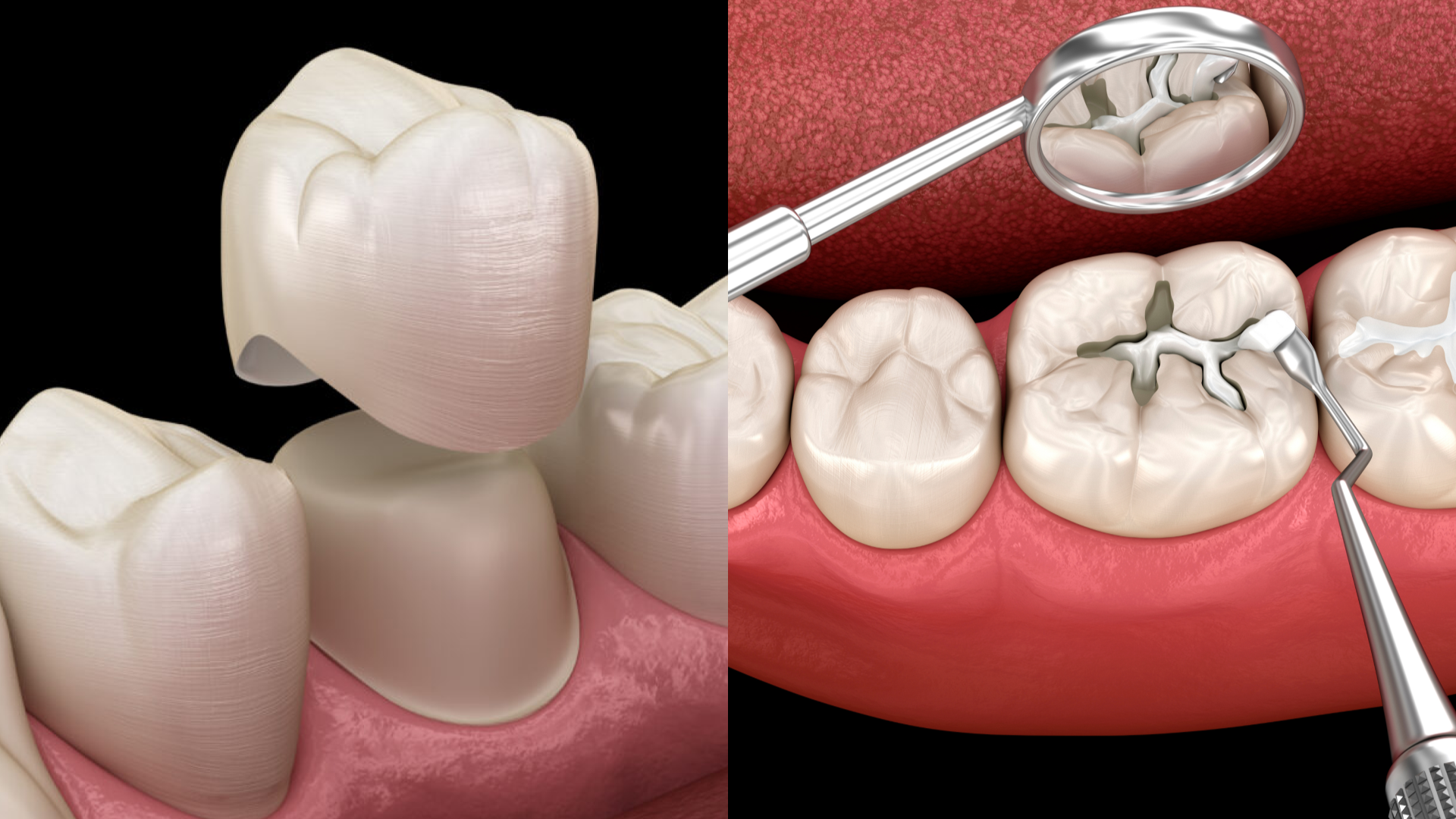 Crowns vs. Fillings: Which One Protects Your Smile Better?